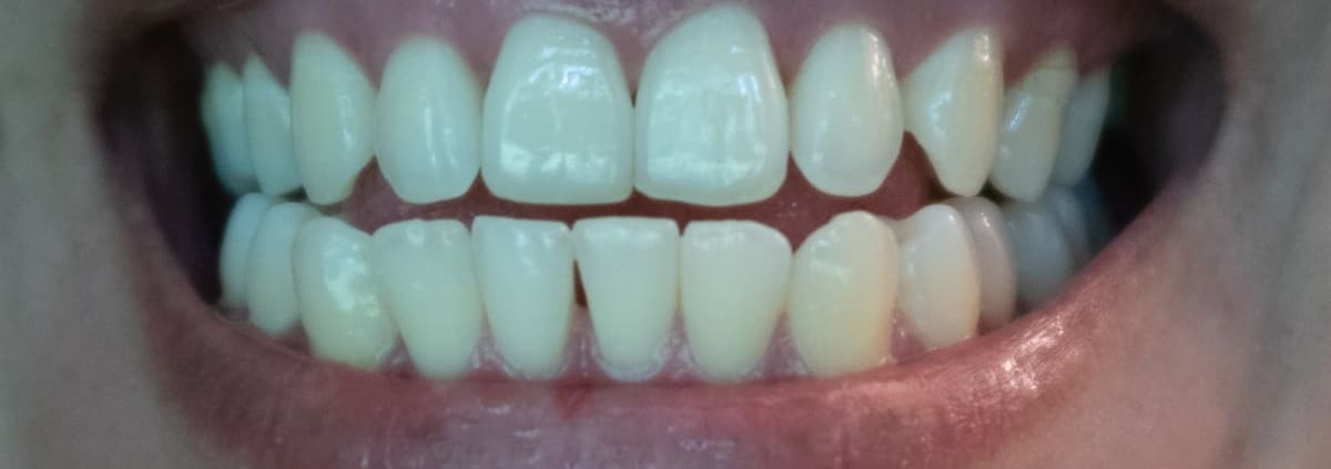 taches de café sur les dents