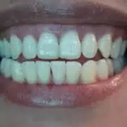 taches de cafe sur les dents taches de café sur les dents