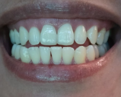 taches de café sur les dents